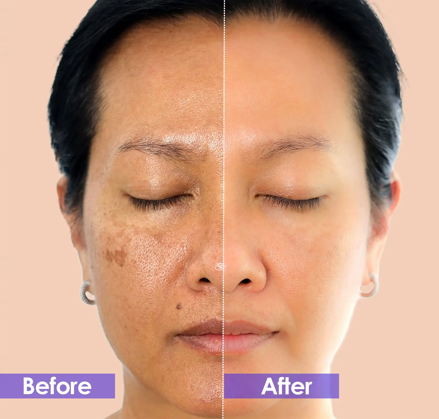 Facial pigmentation removal before and after